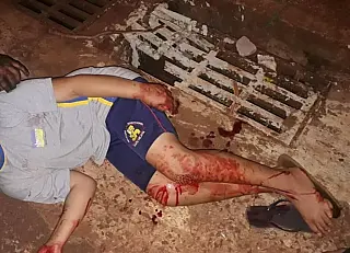 Criança cai em bueiro quebrado e leva 10 pontos no joelho em Dourados