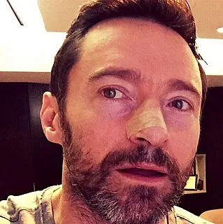 Astro de 'Wolverine', Hugh Jackman retira quinto foco de câncer de pele
