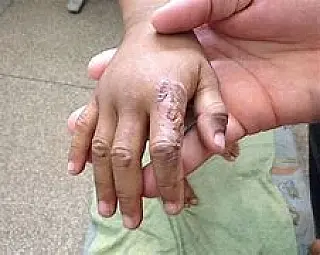 Mãe é denunciada no Conselho Tutelar por queimar as mãos de criança de 5 anos