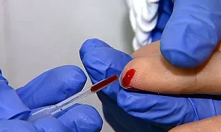 SUS oferecerá teste rápido para chikungunya e dengue