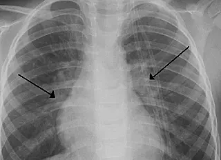 Bronquiolite é a principal causa de internação em bebês