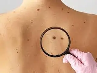 Sábado tem Mutirão de Câncer de Pele no HU