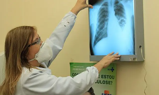 Dourados se previne ao aumento de casos de tuberculose